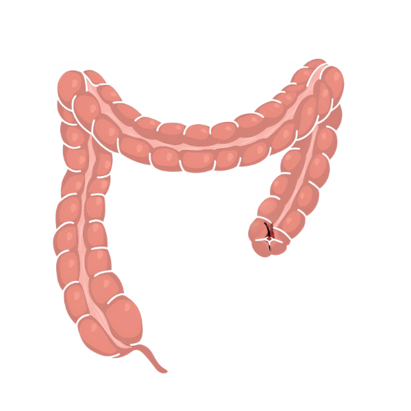 Abdominoperineal Resection