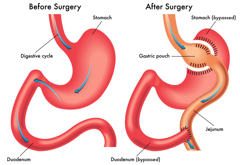 Gastric Surgery