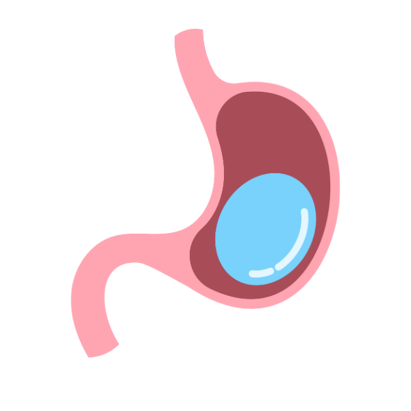 Intra Gastric Balloon Insertion