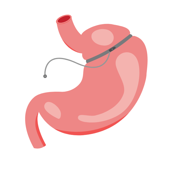 Laparoscopic Adjustable Gastric Banding