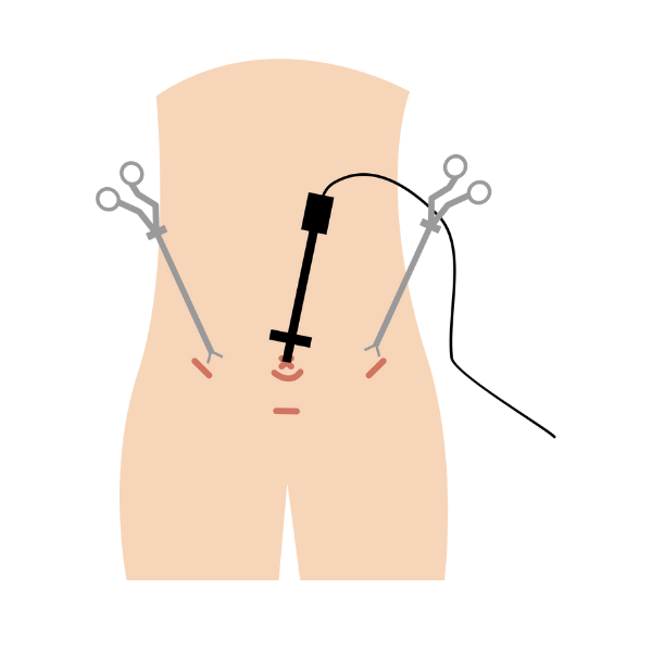 Laparoscopic Heller’s Myotomy