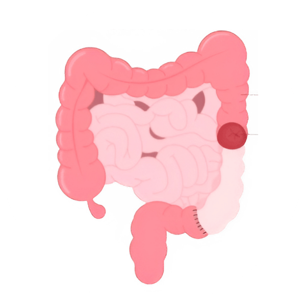 Left hemicolectomy