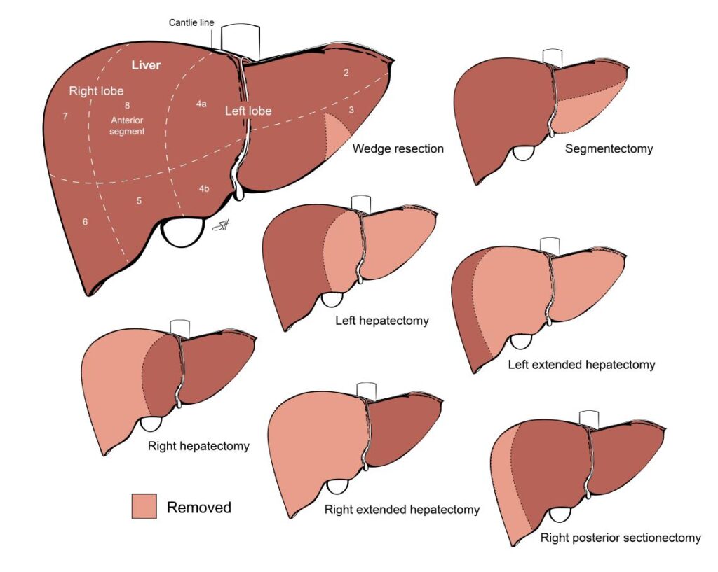 Liver Resection