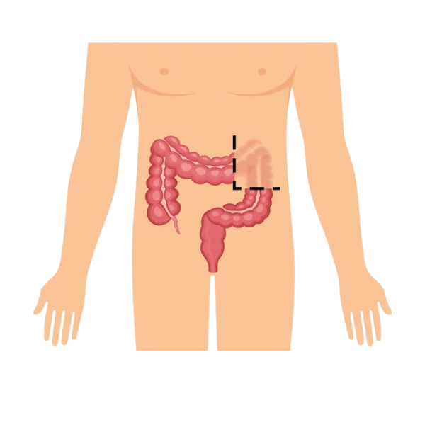 right hemicolectomy